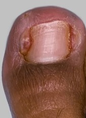 6. Ingrown toenail in right big toe 